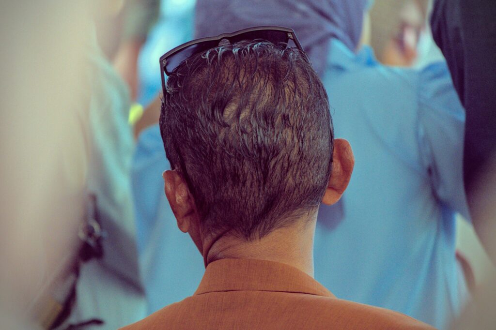 The Ultimate Pre-Procedure Checklist: Preparing for Your Irvine Hair Transplant